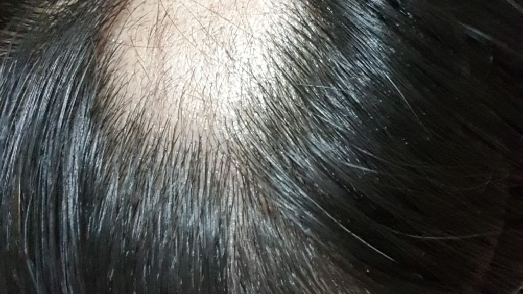 Best Shampoo for Alopecia Areata