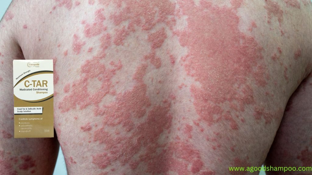 Is Coal Tar Shampoo Good for Psoriasis? 1 Is Coal Tar Shampoo Good for Psoriasis