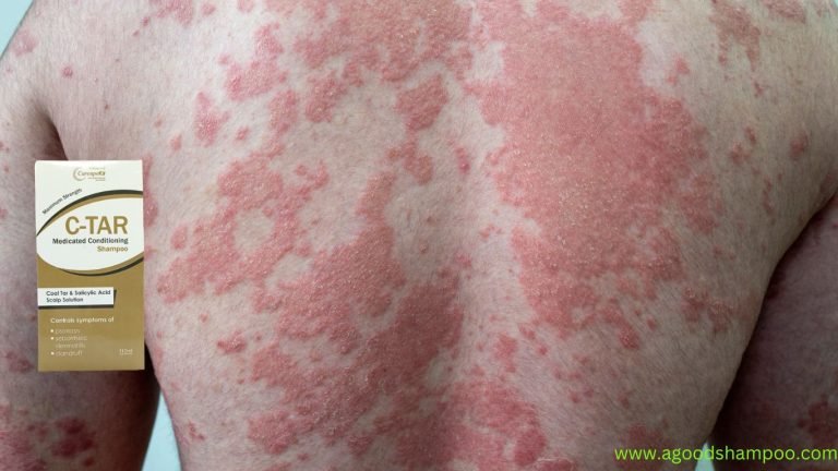 Is Coal Tar Shampoo Good for Psoriasis