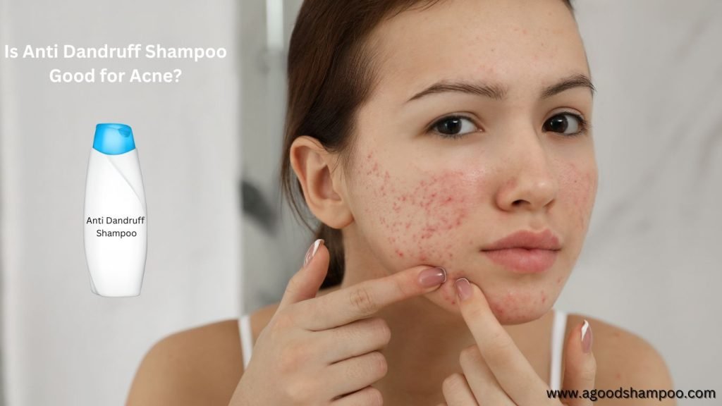 Is Anti Dandruff Shampoo Good for Acne