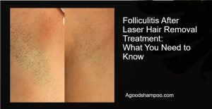 Folliculitis After Laser Hair Removal Treatment