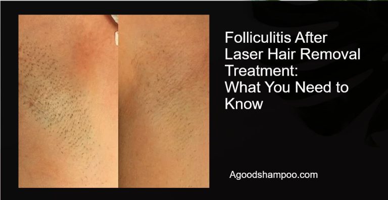 Folliculitis After Laser Hair Removal Treatment: What You Need to Know