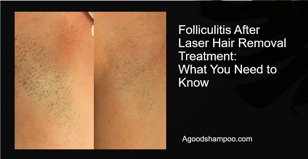 Folliculitis After Laser Hair Removal Treatment