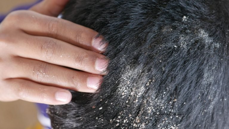 What'S A Good Dandruff Shampoo For Bulldogs