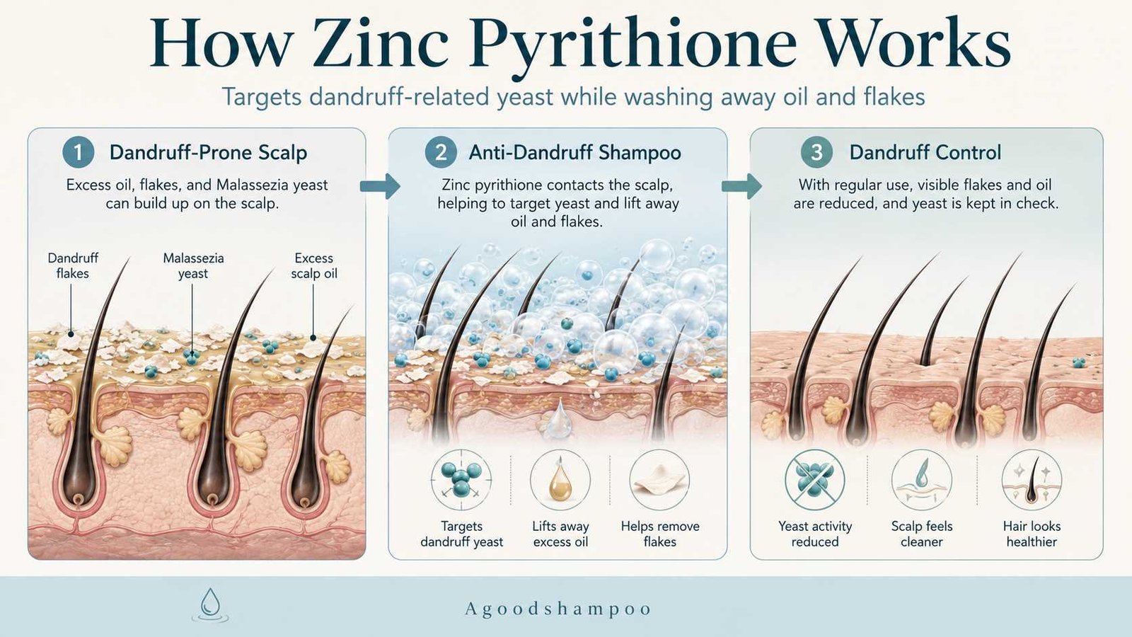 Diagram showing how zinc pyrithione shampoo helps control dandruff